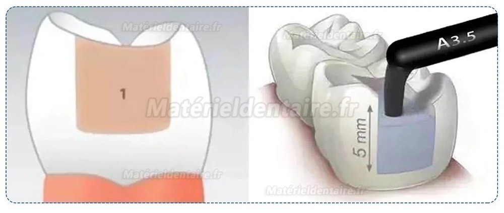 10 Capsules/boîte A1/A2/A3/A3.5 Résine composite dentaire photopolymérisable